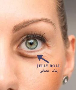 Jelly Roll در پلک تحتانی