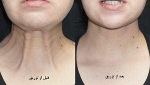 قبل و بعد از تزریق بوتاکس گردن