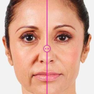 بوتاکس خط ماریونت