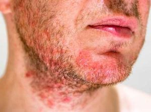  seborrheic dermatitis in face 