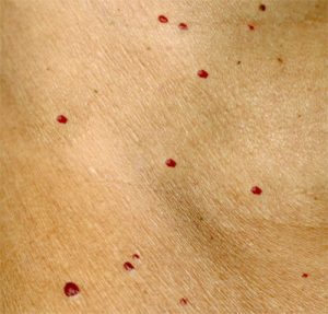 آنژیوم گیلاسی متعدد