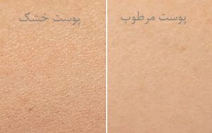 تفاوت پوست خشک و مرطوب