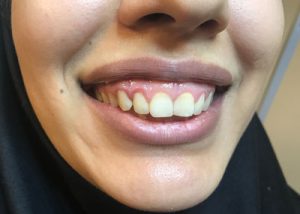 لبخند لثه ای