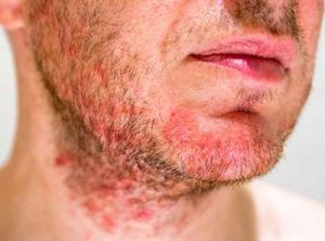 seborrheic dermatitis in face