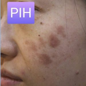 لکهای تیره ناشی از التهاب پوست